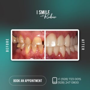 Blog 158 mexico-full-mouth-restoration