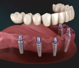 Home 23 same-day-teeth-implants