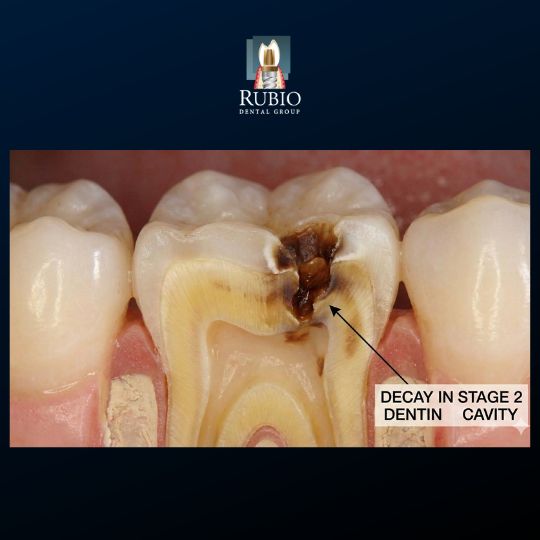Tooth cross section showing decay entering dentin Stage 2 cavity