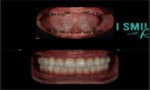 Blog 135 dental-care-in-algodones