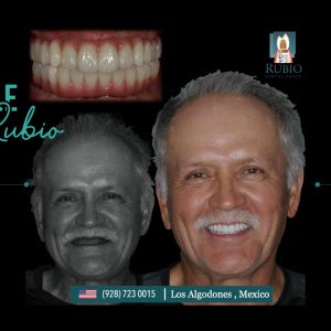 Blog 137 dentist-in-algodones-baja-california