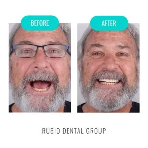 Home 12 dental-veneers