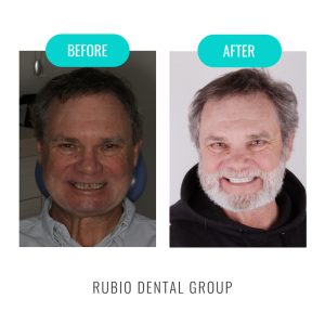 Dental laser in Mexico: painless and without anesthesia 3 before after 4